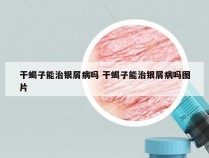 干蝎子能治银屑病吗 干蝎子能治银屑病吗图片
