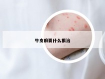 牛皮癣要什么根治