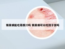 银屑病能吃葛根汁吗 银屑病可以吃鸽子蛋吗
