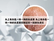 头上有白色一块一块的头皮屑 头上有白色一块一块的头皮屑扣掉还长一扣掉头皮红
