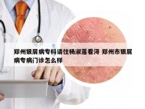 郑州银屑病专科请往杨淑莲看浔 郑州市银屑病专病门诊怎么样