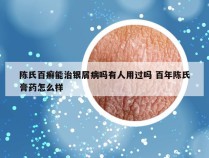 陈氏百癣能治银屑病吗有人用过吗 百年陈氏膏药怎么样