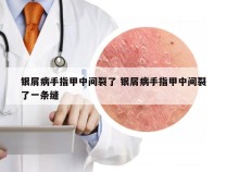 银屑病手指甲中间裂了 银屑病手指甲中间裂了一条缝