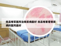 南昌哪家医院治银屑病最好 南昌哪里看银屑病的医院最好
