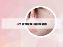 m外阴银屑病 阴部银屑病