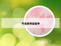 牛皮癣传染指甲