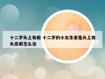 十二岁头上有癣 十二岁的小女生老是头上有头皮癣怎么治