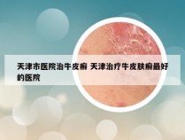 天津市医院治牛皮癣 天津治疗牛皮肤癣最好的医院