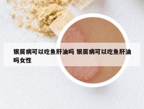银屑病可以吃鱼肝油吗 银屑病可以吃鱼肝油吗女性