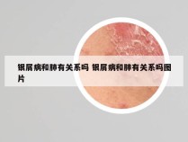 银屑病和肺有关系吗 银屑病和肺有关系吗图片