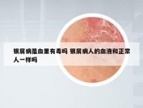 银屑病是血里有毒吗 银屑病人的血液和正常人一样吗