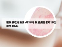 银屑病吃维生素a可以吗 银屑病患者可以吃维生素b吗