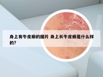 身上有牛皮癣的图片 身上长牛皮癣是什么样的?