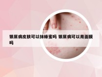 银屑病皮肤可以抹蜂蜜吗 银屑病可以用面膜吗