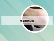 银屑病传秘方