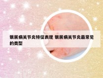 银屑病关节炎特征表现 银屑病关节炎最常见的类型
