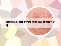 银屑病年纪大能吃钙片 银屑病患者需要补钙吗