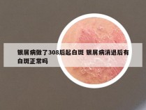 银屑病做了308后起白斑 银屑病消退后有白斑正常吗
