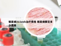 银屑病311uvb治疗费用 银屑病要花多少费用