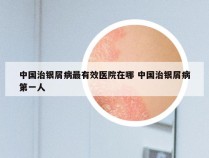 中国治银屑病最有效医院在哪 中国治银屑病第一人