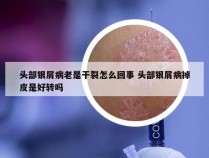 头部银屑病老是干裂怎么回事 头部银屑病掉皮是好转吗