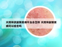 大斑块状副银屑病不治会怎样 大斑块副银屑病可以痊愈吗