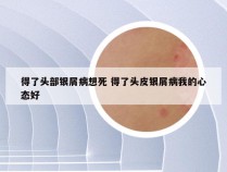 得了头部银屑病想死 得了头皮银屑病我的心态好