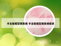 手足脓疱型银屑病 手足脓疱型银屑病症状