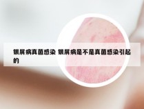银屑病真菌感染 银屑病是不是真菌感染引起的