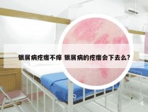 银屑病疙瘩不痒 银屑病的疙瘩会下去么?