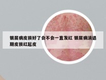 银屑病皮损好了会不会一直发红 银屑病消退期皮损红起皮