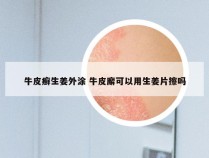 牛皮癣生姜外涂 牛皮廨可以用生姜片擦吗