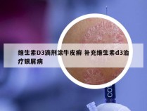 维生素D3滴剂涂牛皮癣 补充维生素d3治疗银屑病