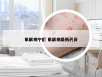 银屑病宁酊 银屑病最新药膏