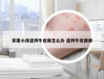 家里小孩遗传牛皮癣怎么办 遗传牛皮肤癣