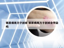银屑病用刀子刮掉 银屑病用刀子刮掉会传染吗