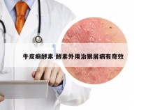 牛皮癣酵素 酵素外用治银屑病有奇效