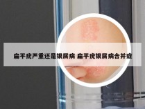 扁平疣严重还是银屑病 扁平疣银屑病合并症