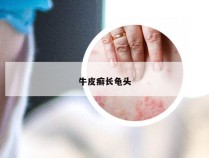 牛皮癣长龟头