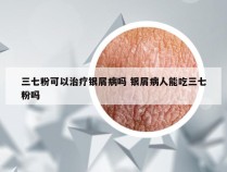 三七粉可以治疗银屑病吗 银屑病人能吃三七粉吗
