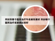 开封市那个医院治疗牛皮癣效果好 开封哪个医院治疗皮肤病比较好