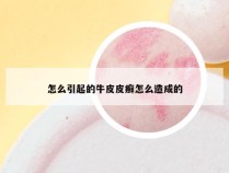 怎么引起的牛皮皮癣怎么造成的