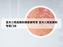 吉大二院皮肤科银屑病专家 吉大二院皮肤科专家门诊