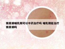 银屑病哺乳期可以中药治疗吗 哺乳期能治疗银屑病吗