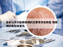 目前认为引起银屑病的主要发生机制是 银屑病的典型损害为