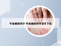 牛皮癣的印子 牛皮癣的印子消不下去