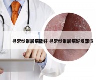 寻常型银屑病能好 寻常型银屑病好发部位