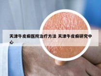 天津牛皮癣医院治疗方法 天津牛皮癣研究中心