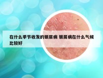 在什么季节收发的银屑病 银屑病在什么气候比较好