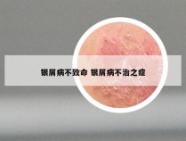银屑病不致命 银屑病不治之症